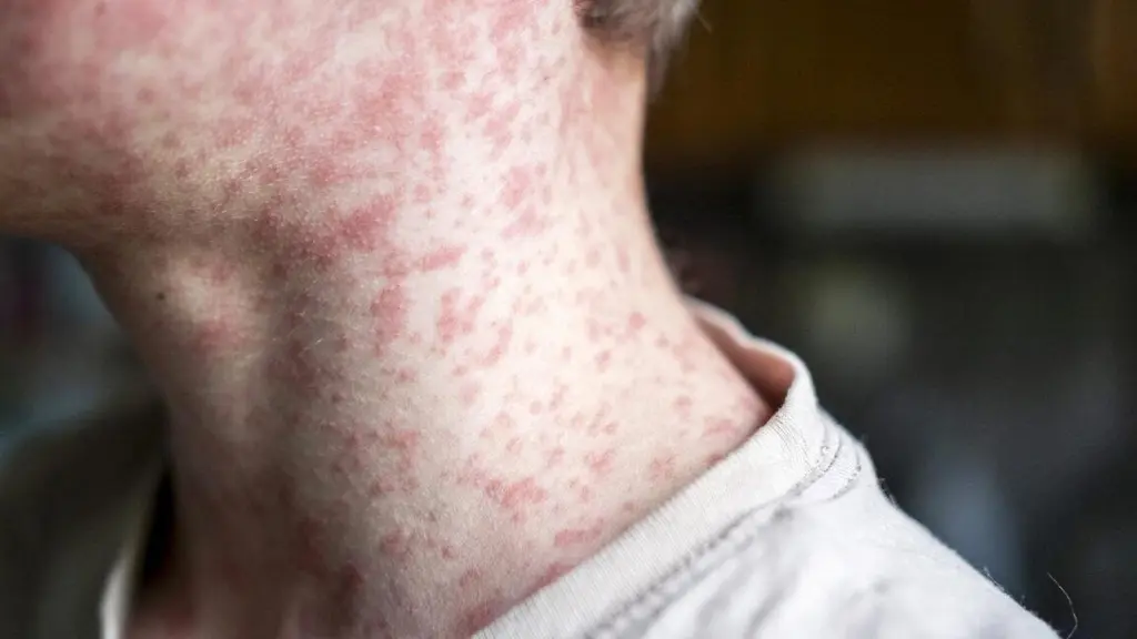 Measles kills 18-year-old in PA, 4th death as state outbreak nears 700 cases