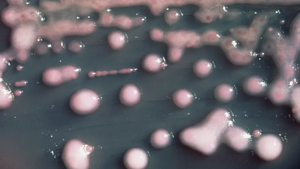 Woman loses vision in one eye after UTI bacteria evolves to invade her brain