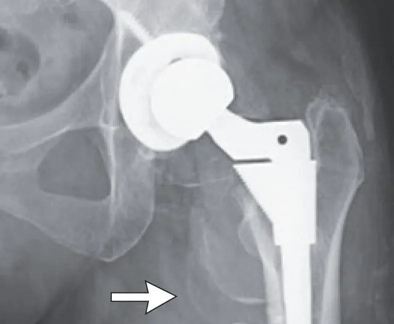 Woman's puzzling decline turns out to be cobalt poisoning from hip replacement