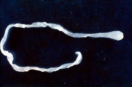 Surprised doctors find 10-inch worm in man's groin during elective surgery