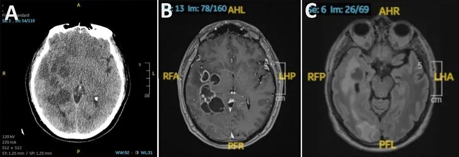 Doctors suspected man had brain cancer. He actually had worms.